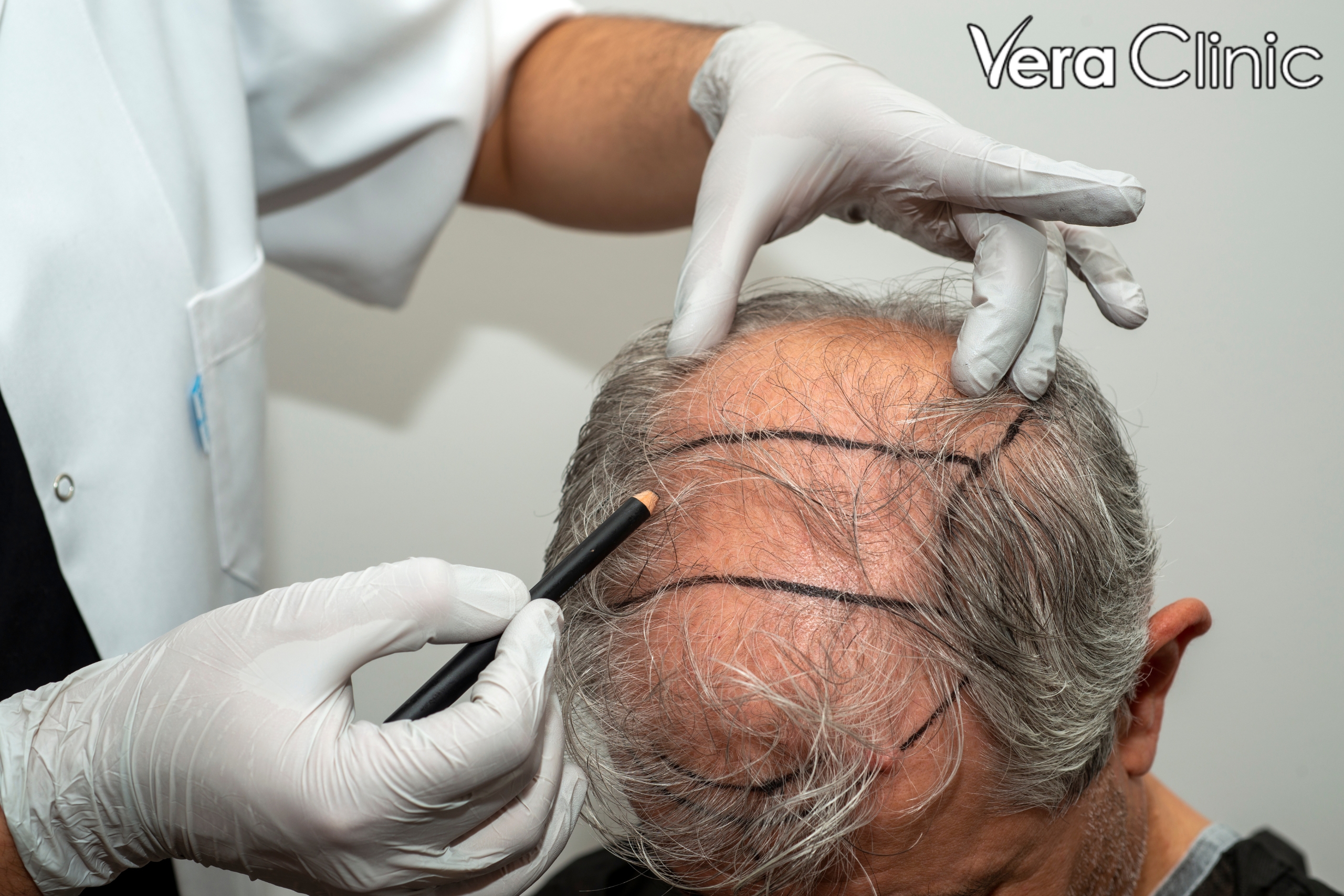 istanbul hair transplant
